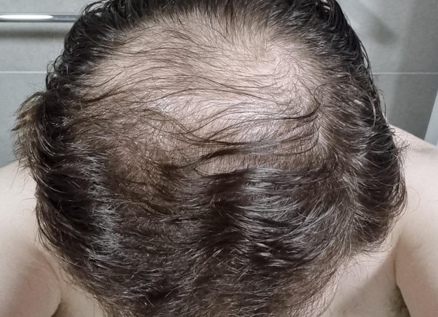 Как следить за лысой или бритой головой?